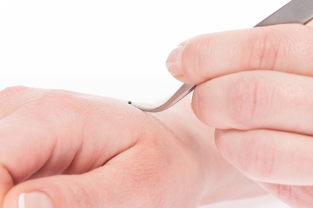 tick tweezers for humans stainless